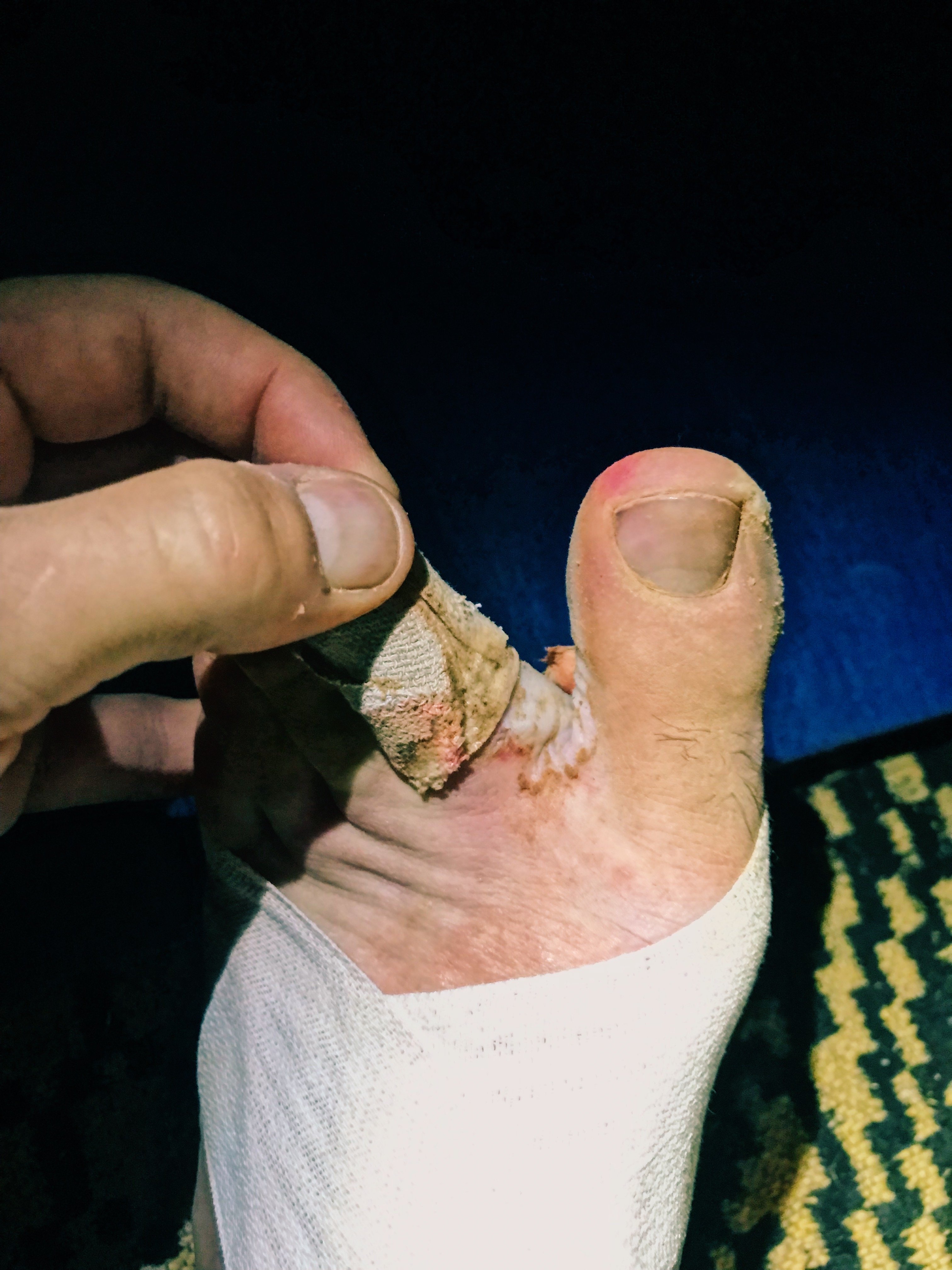 Marathon Des Sables blisters